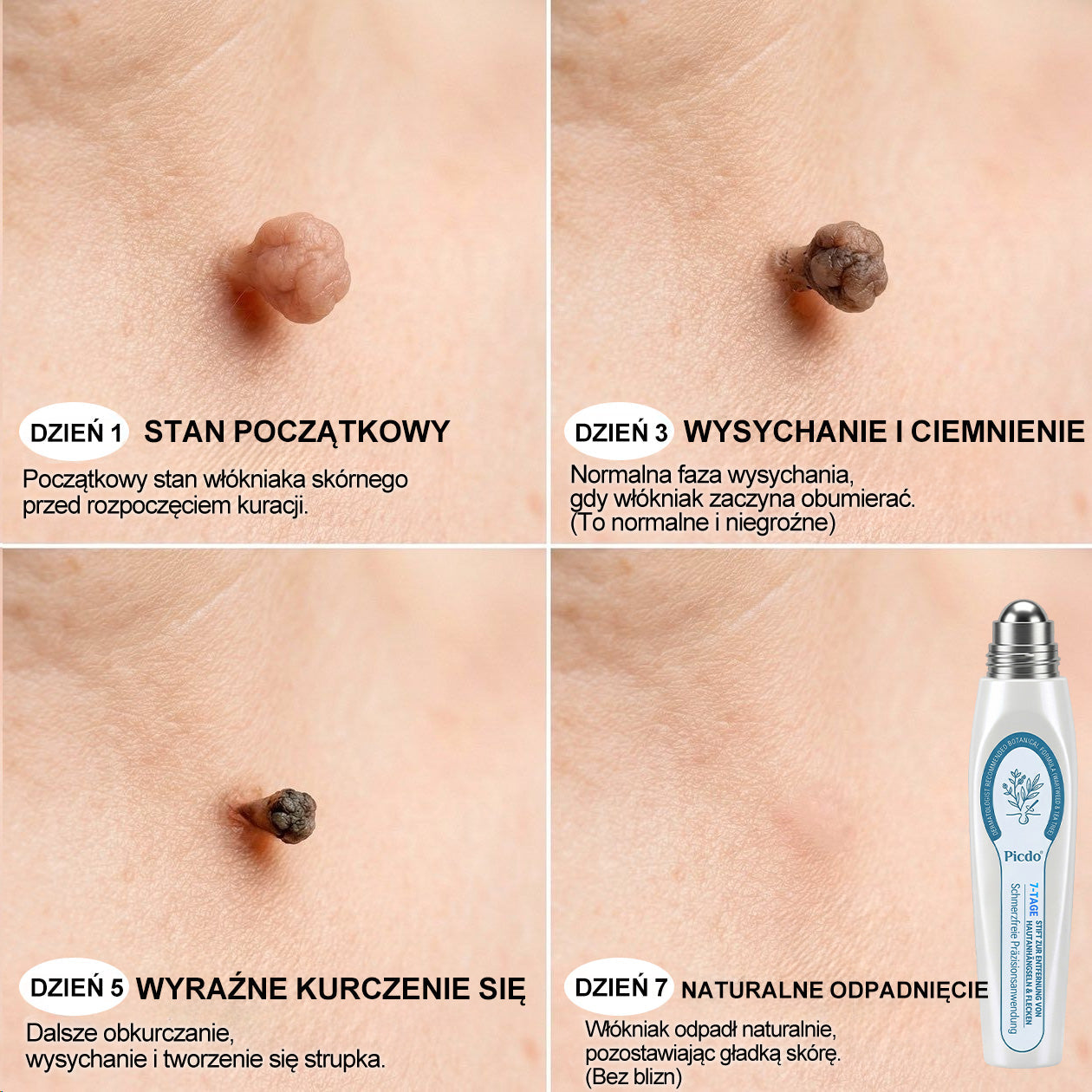 𝐏i𝐜𝐝o® 🌱7 𝑫𝒏𝒊 𝑷𝒓𝒆𝒑𝒂𝒓𝒂𝒕 𝑫𝒐 𝑼𝒔𝒖𝒘𝒂𝒏𝒊𝒂 𝑾łó𝒌𝒏𝒊𝒂𝒌ó𝒘 𝑴𝒊ę𝒌𝒌𝒊𝒄𝒉 𝑰 𝑷𝒓𝒛𝒆𝒃𝒂𝒓𝒘𝒊𝒆ń(𝐁𝐞𝐳 𝐁ó𝐥𝐮, 𝐁𝐞𝐳 𝐁𝐥𝐢𝐳𝐧 – 𝐑𝐨𝐥𝐥-𝐨𝐧)💪